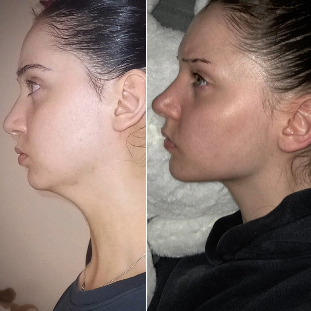 Side profile · forward jaw projection