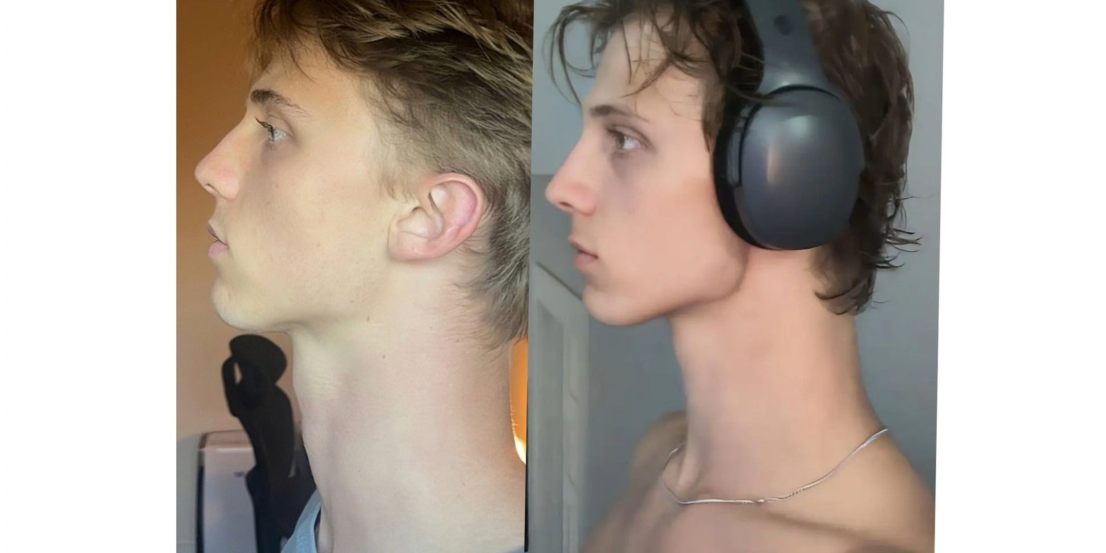 Side profile · maxillary forward growth