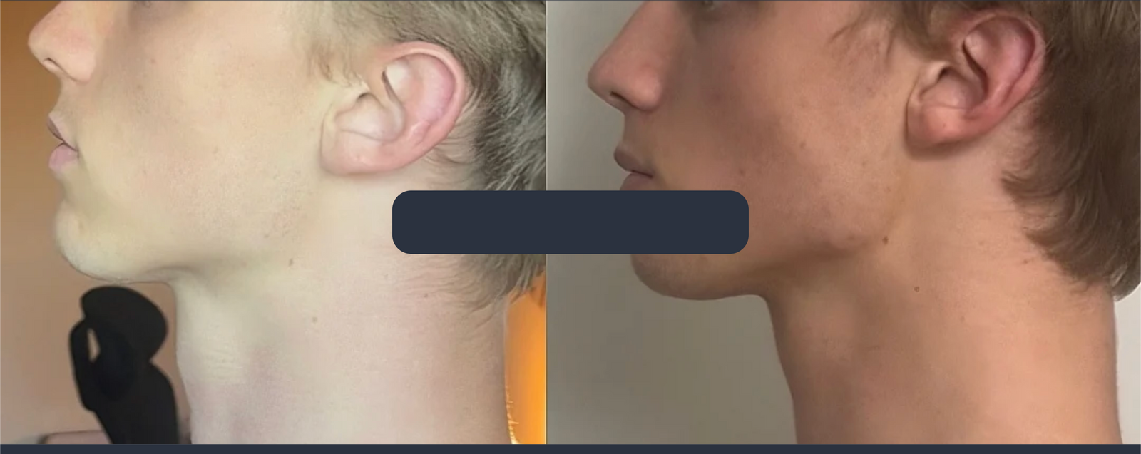 Side profile · maxillary forward growth