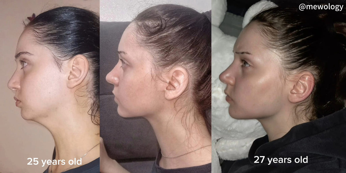 Side profile · forward jaw projection