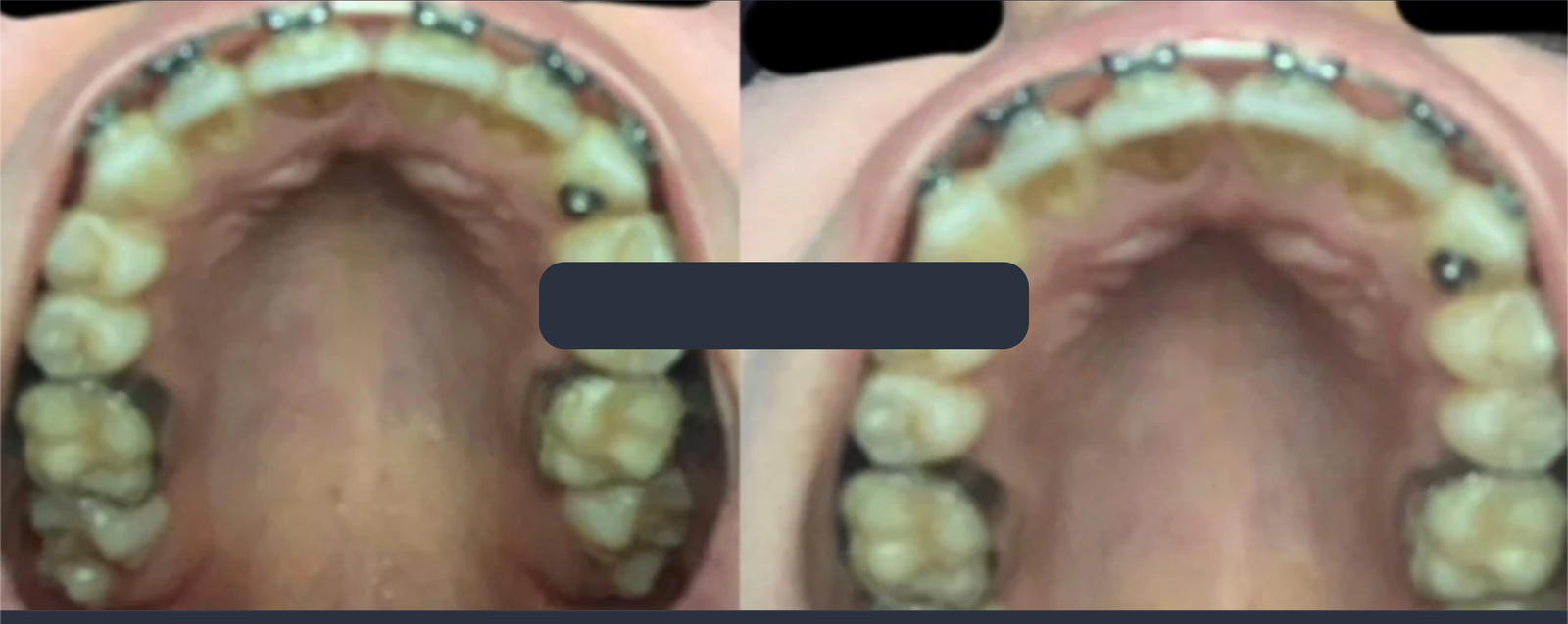 Palate · visible arch expansion